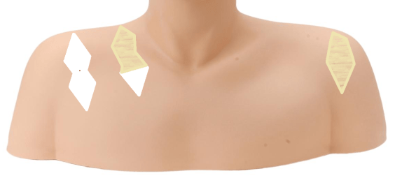 The areas marked in white are pressure marks with unambiguous and distinct borders. The areas marked in beige are also pressure marks, but their shape is less clear from photos.